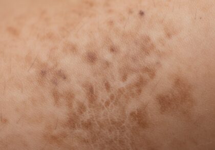 هایپرپیگمانتاسیون